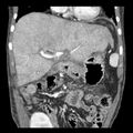Biliary necrosis - liver transplant (Radiopaedia 21876-21846 C 16).jpg