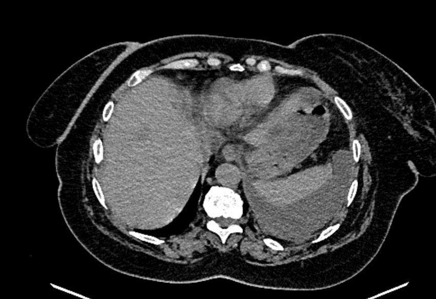 Biliary pancreatitis (Radiopaedia 72289-82823 Axial non-contrast 48).jpg