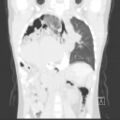 Bochdalek diaphragmatic hernia (Radiopaedia 38866-41059 Coronal lung window 12).jpg