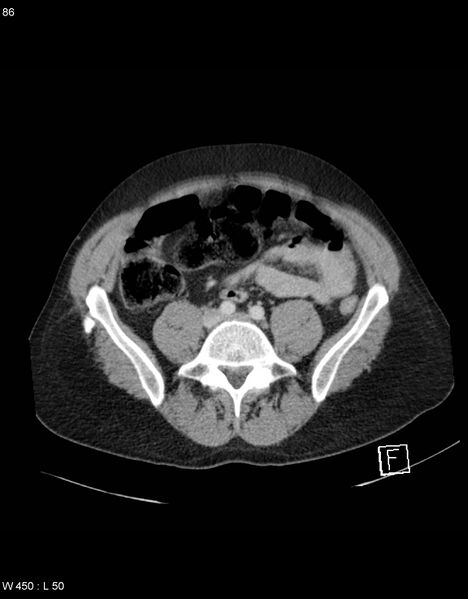 File:Boerhaave syndrome with tension pneumothorax (Radiopaedia 56794-63603 A 43).jpg