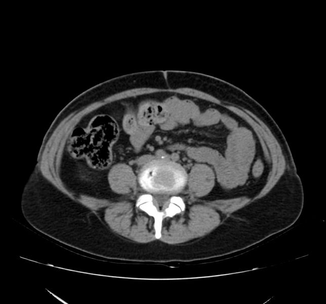 File:Bosniak renal cyst - type IV (Radiopaedia 22929-22953 Axial non-contrast 37).jpg