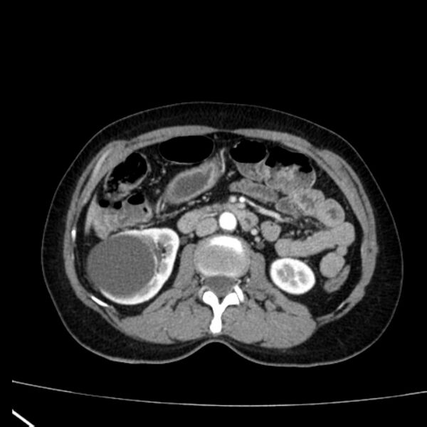 File:Bosniak renal cyst - type I (Radiopaedia 27479-27675 renal cortical phase 38).jpg