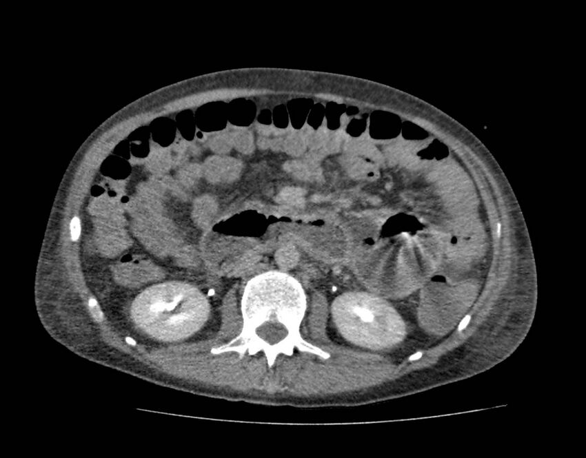 Bowel lymphoma complicated by bleeding after therapy (Radiopaedia 55601-62110 C 39).jpg