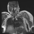 Brachial plexopathy (Radiopaedia 21844-21806 Coronal T1 C+ 7).jpg