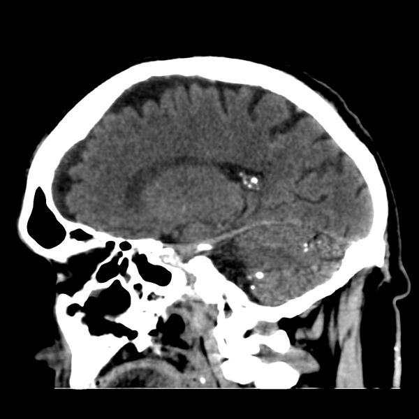 File:Brain Pantopaque remnants (Radiopaedia 78403-91048 C 35).jpg