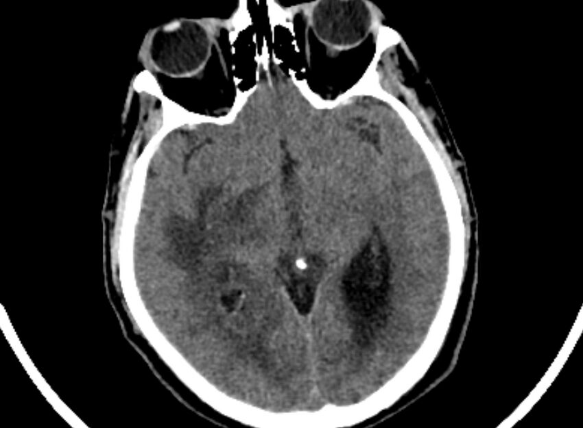 Brain abscess complicated by intraventricular rupture and ventriculitis (Radiopaedia 82434-96575 Axial non-contrast 29).jpg