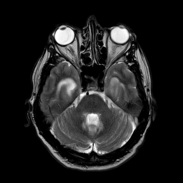 File:Brain abscess complicated by intraventricular rupture and ventriculitis (Radiopaedia 82434-96577 Axial T2 6).jpg