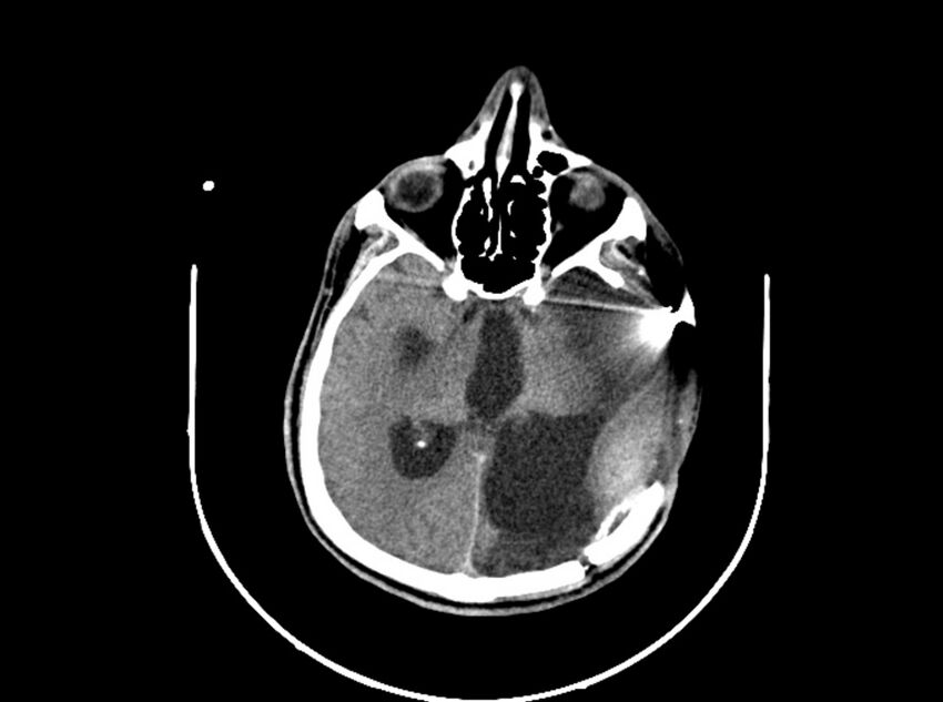 Brain injury by firearm projectile (Radiopaedia 82068-96088 A 120).jpg