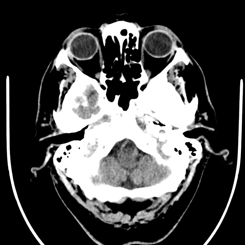 Brain metastasis (Radiopaedia 42617-45760 Axial non-contrast 4).jpg