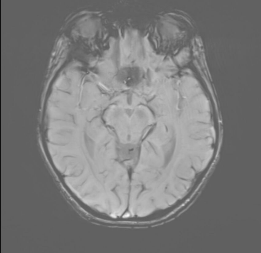 Brainstem glioma (Radiopaedia 70548-80674 Axial SWI 26).jpg