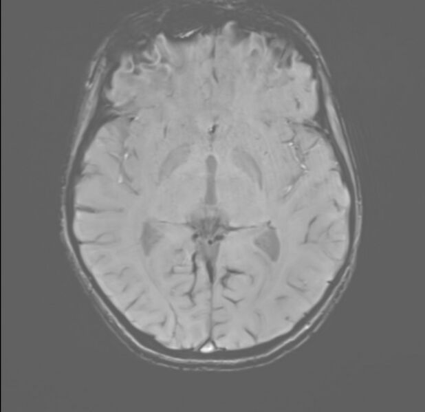 File:Brainstem glioma (Radiopaedia 70548-80674 Axial SWI 30).jpg