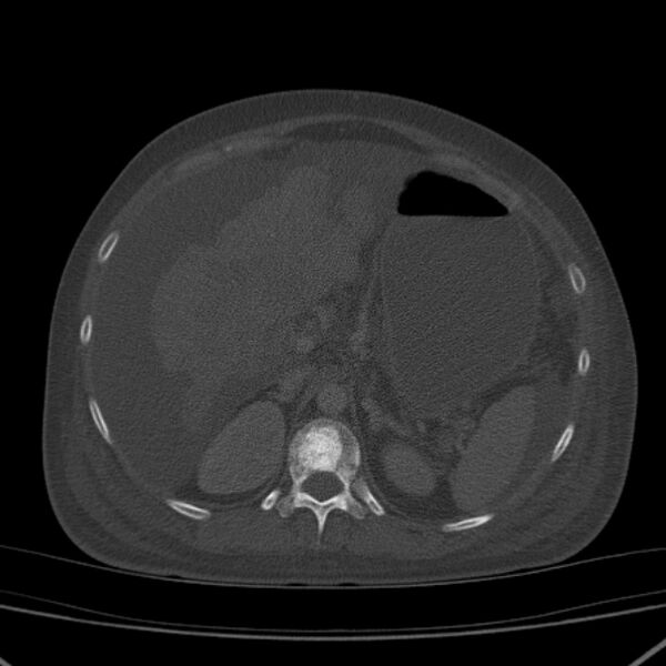 File:Breast cancer metastases - hepatic and skeletal (Radiopaedia 34201-35461 Axial bone window 44).jpg