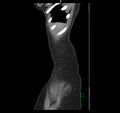 Broad ligament hernia (Radiopaedia 63260-71832 C 2).jpg