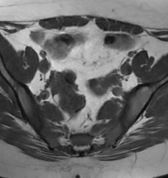 File:Broad ligament leiomyoma (Radiopaedia 81634-95516 Axial T1 8).jpg