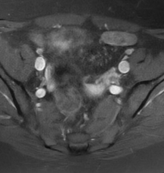 File:Broad ligament leiomyoma (Radiopaedia 81634-95516 Axial T1 C+ fat sat 8).jpg