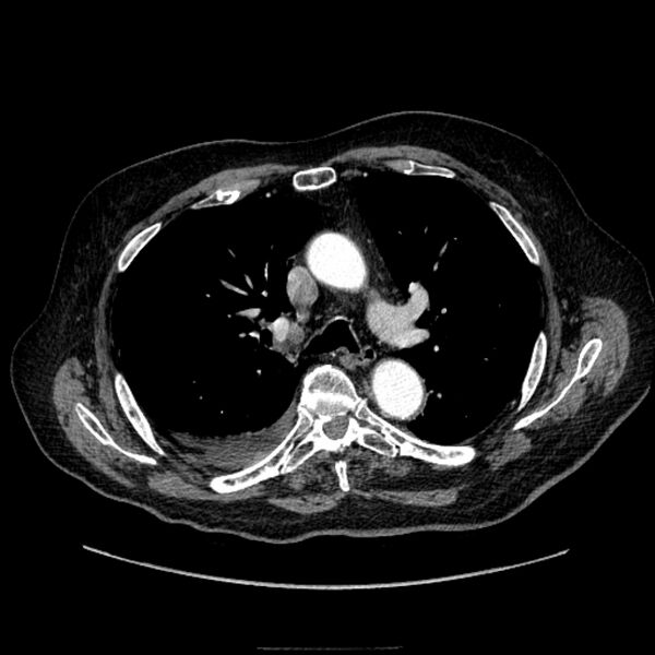 File:Bronchogenic adenocarcinoma and pulmonary embolism (Radiopaedia 9097-9806 D 26).jpg