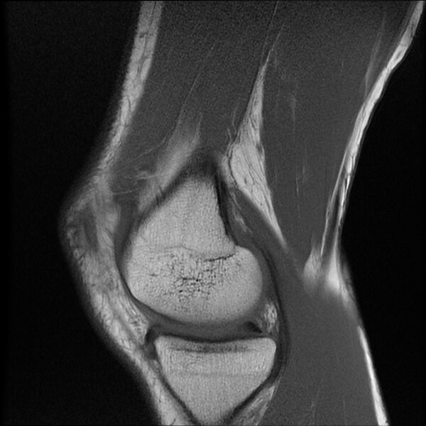 File:Bucket-handle meniscus tear (Radiopaedia 65700-74809 Sagittal T1 8).jpg