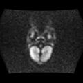 Burkitt lymphoma of the orbit- pre and post chemotherapy (Radiopaedia 31214-31929 Axial DWI 1).jpg