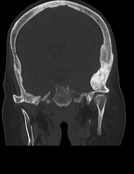 File:Burnt-out meningioma (Radiopaedia 51557-57337 Coronal bone window 23).jpg
