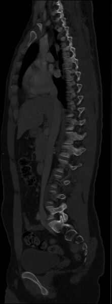 File:Burst fracture (Radiopaedia 83168-97542 Sagittal bone window 61).jpg