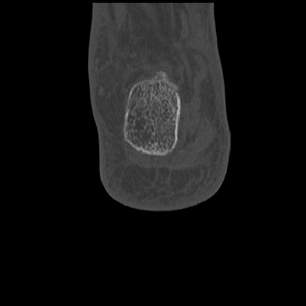 File:Calcaneal tuberosity avulsion fracture (Radiopaedia 22649-22668 Coronal bone window 59).jpg