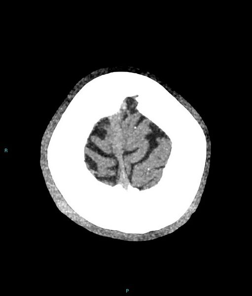 File:Calcified cerebral emboli from left ventricular thrombus (Radiopaedia 84420-99758 B 2).jpg