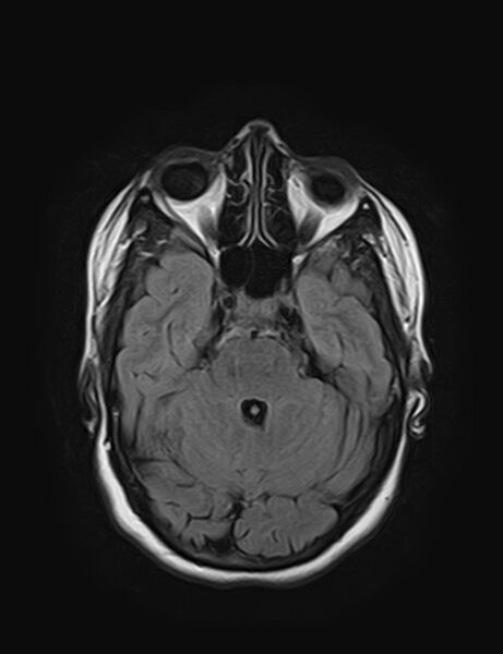 File:Calcified cerebral hydatid cyst (Radiopaedia 65603-74699 Axial FLAIR 7).jpg