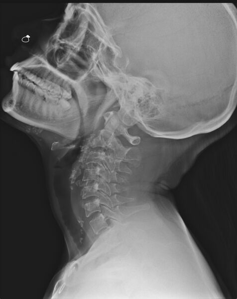 File:Calcified cervical nodes (Radiopaedia 23030-23058 Lateral 1).jpg