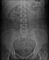 Calcified fibroid (Radiopaedia 16272-15952 A 1).jpg