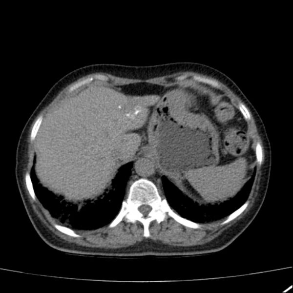 File:Calcified hepatic hydatid cyst (Radiopaedia 26872-27046 Axial non-contrast 17).jpg