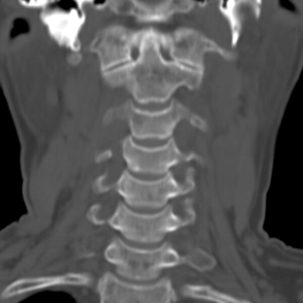 File:Calcified meningioma - cervical canal (Radiopaedia 70136-80171 Coronal bone window 3).jpg