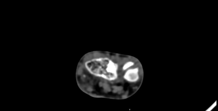Calcifying aponeurotic fibroma (Radiopaedia 88423-105064 B 32).jpg