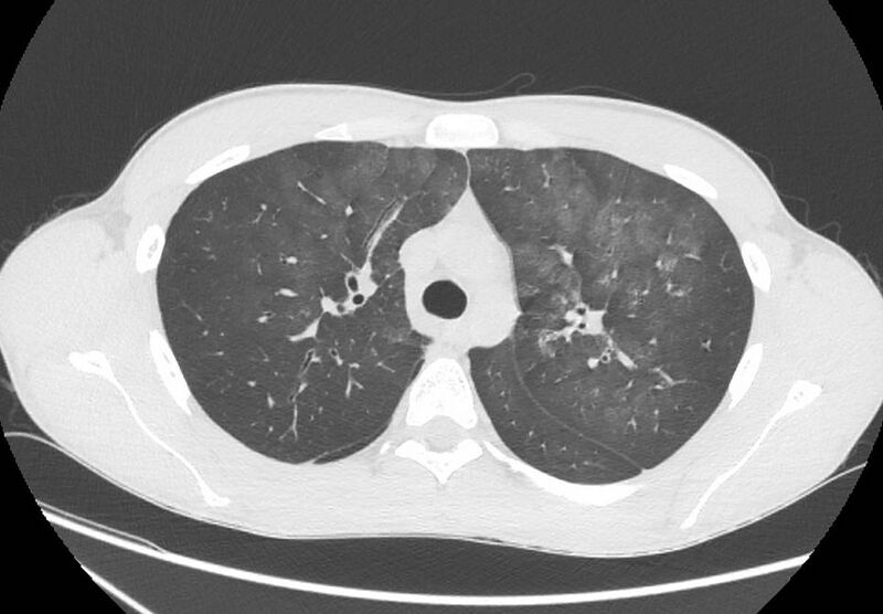 File:Cannabis-induced diffuse alveolar hemorrhage (Radiopaedia 89834-106946 Axial lung window 36).jpg