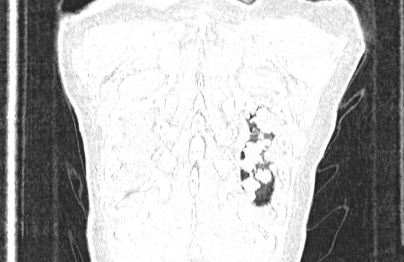 File:Cannonball metastases from breast cancer (Radiopaedia 91024-108569 Coronal lung window 136).jpg