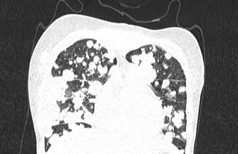 File:Cannonball metastases from breast cancer (Radiopaedia 91024-108569 Coronal lung window 40).jpg