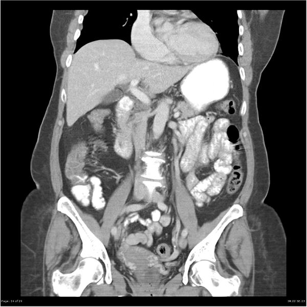 File:Carcinoid tumor of the ileum with metastasis to orbit (Radiopaedia 28165-28425 B 14).jpg