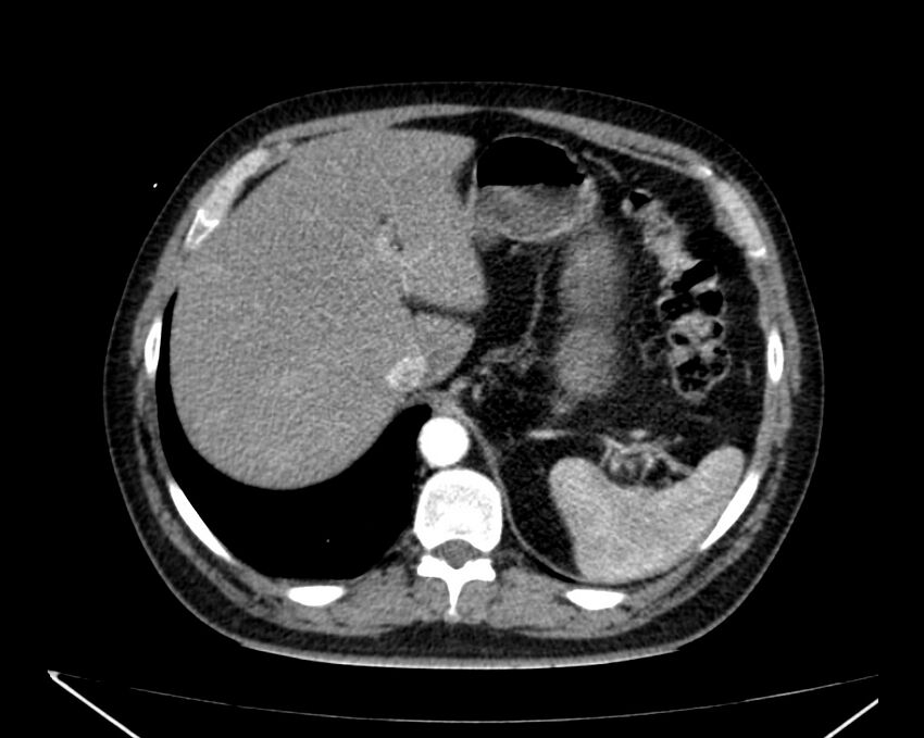 Carcinoid tumor with hepatic metastases (Radiopaedia 22651-22670 B 18).jpg