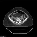 Carcinoma cervix- brachytherapy applicator (Radiopaedia 33135-34173 Axial non-contrast 1).jpg