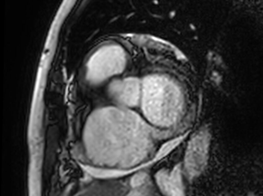 Cardiac amyloidosis (Radiopaedia 61600-69579 Short axis bSSFP 326).jpg