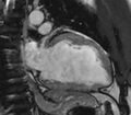 Cardiac sarcoidosis (Radiopaedia 39811-42243 B 1).jpg