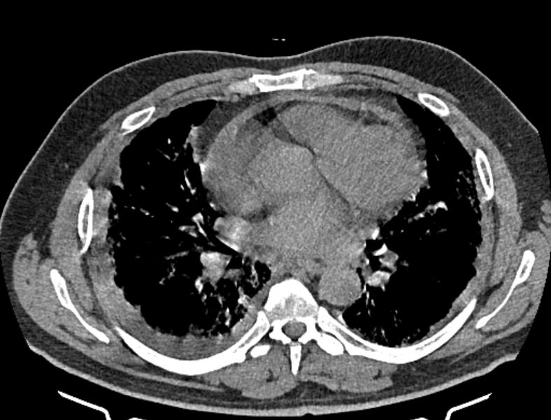 File:Cardiogenic pulmonary edema (Radiopaedia 68180-77678 Axial non-contrast 28).jpg