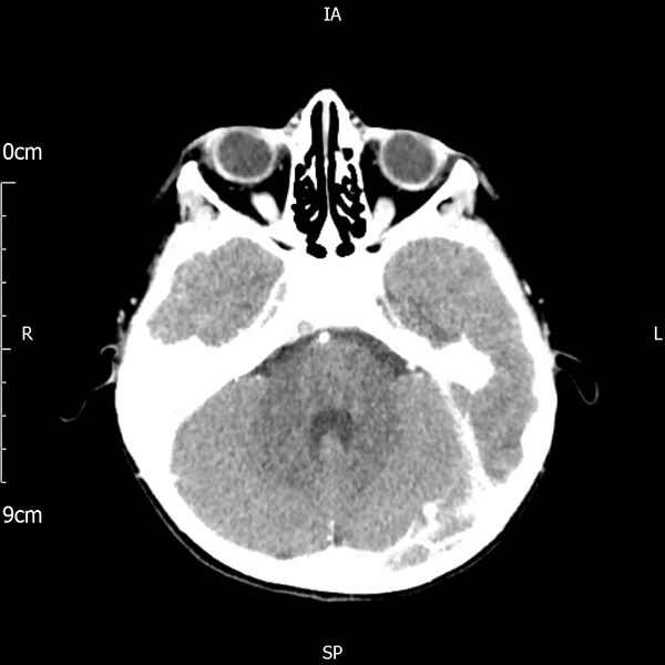 File:Cavernous sinus thrombosis (Radiopaedia 79414-92510 Axial Brain 73).jpg