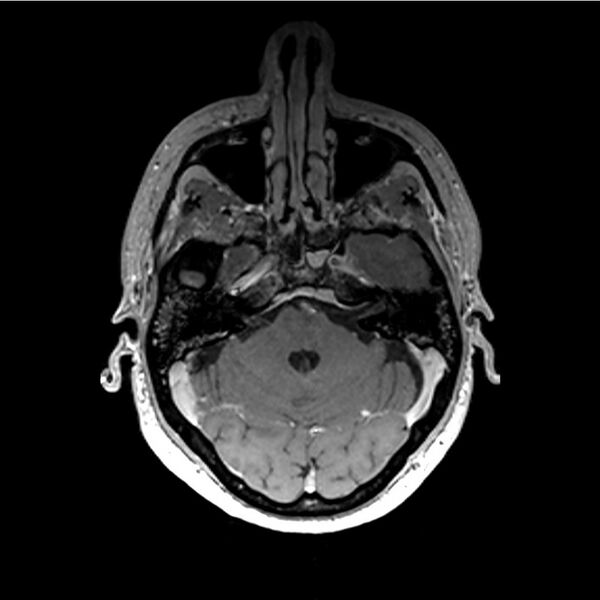File:Central base of skull meningioma (Radiopaedia 53531-59549 Axial T1 C+ 5).jpg