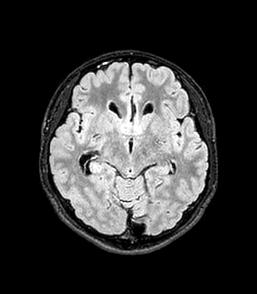 Central neurocytoma (Radiopaedia 79320-92380 Axial FLAIR 181).jpg