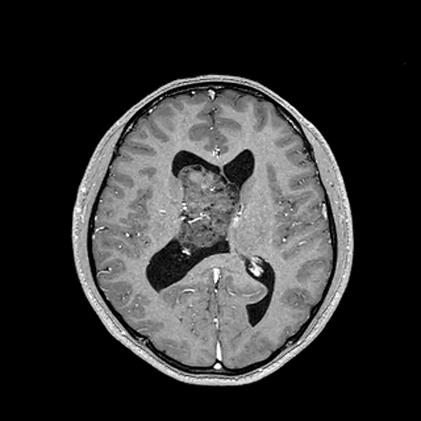 Central neurocytoma (Radiopaedia 79320-92380 Axial T1 C+ 139).jpg
