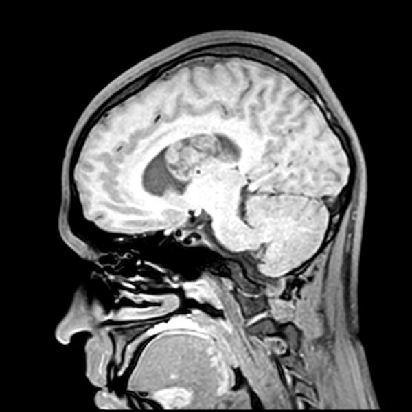File:Central neurocytoma (Radiopaedia 79320-92380 Sagittal T1 114).jpg