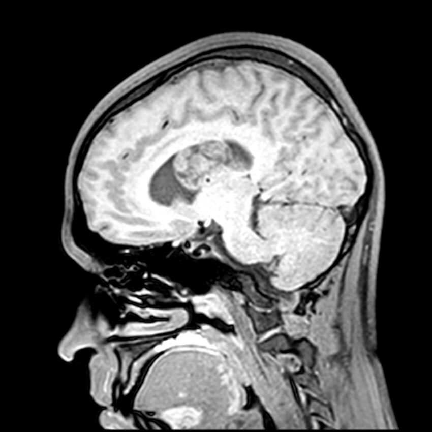 Central neurocytoma (Radiopaedia 79320-92380 Sagittal T1 114).jpg