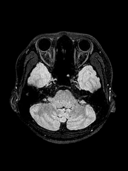 File:Central neurocytoma (Radiopaedia 79320-92381 Axial FLAIR 124).jpg