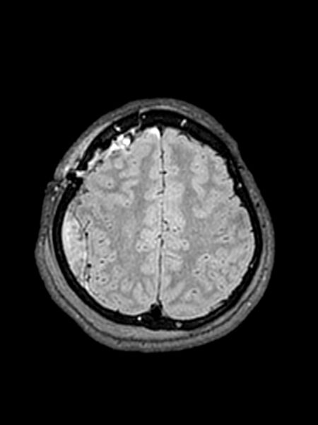 File:Central neurocytoma (Radiopaedia 79320-92381 Axial FLAIR 49).jpg