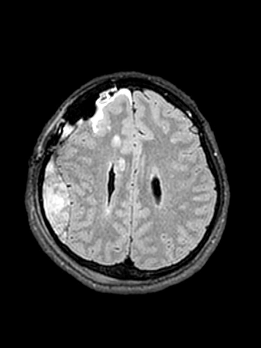 Central neurocytoma (Radiopaedia 79320-92381 Axial FLAIR 59).jpg